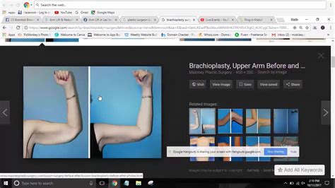 brachioplasty las vegas